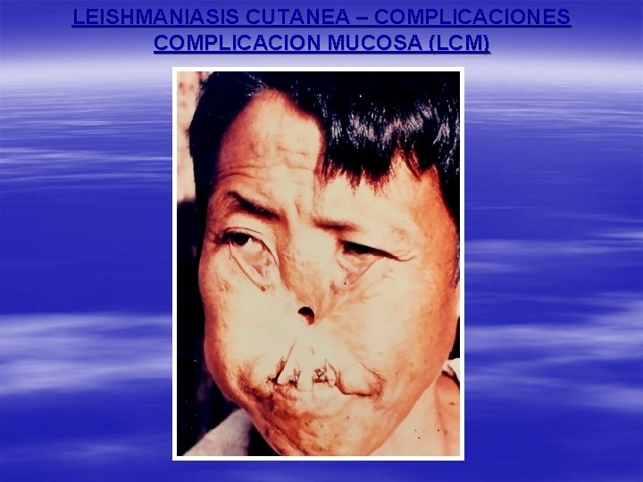 LEISHMANIASIS CUTANEA – COMPLICACIONES COMPLICACION MUCOSA (LCM) 