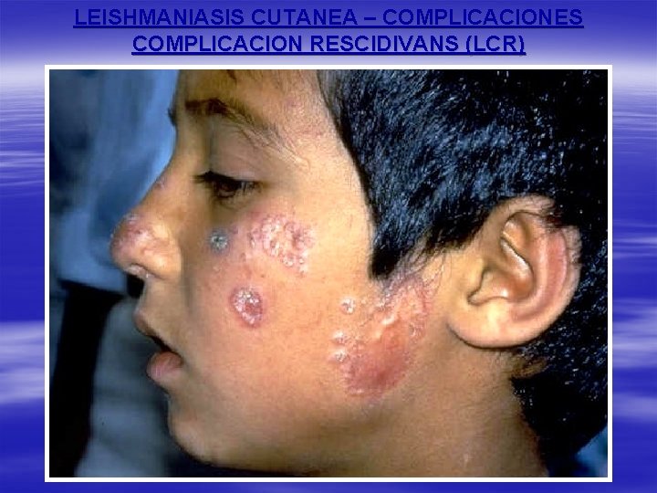 LEISHMANIASIS CUTANEA – COMPLICACIONES COMPLICACION RESCIDIVANS (LCR) 