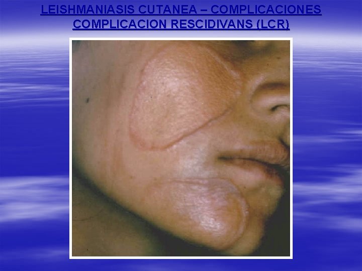 LEISHMANIASIS CUTANEA – COMPLICACIONES COMPLICACION RESCIDIVANS (LCR) 