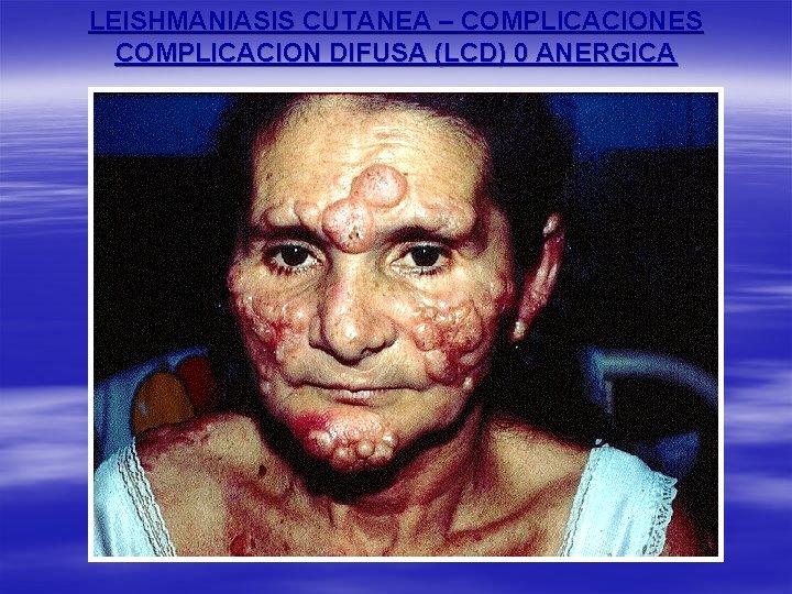 LEISHMANIASIS CUTANEA – COMPLICACIONES COMPLICACION DIFUSA (LCD) 0 ANERGICA 