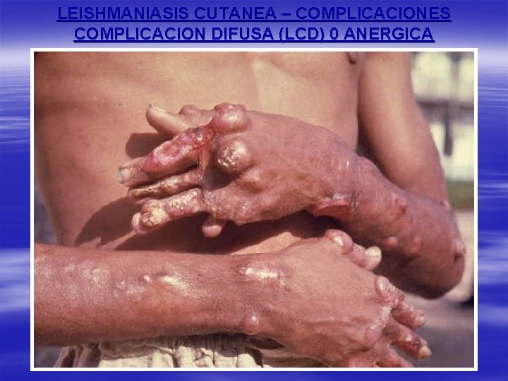 LEISHMANIASIS CUTANEA – COMPLICACIONES COMPLICACION DIFUSA (LCD) 0 ANERGICA 