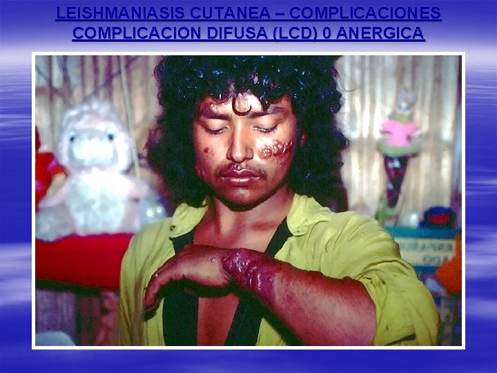 LEISHMANIASIS CUTANEA – COMPLICACIONES COMPLICACION DIFUSA (LCD) 0 ANERGICA 