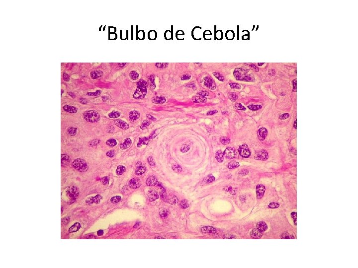 “Bulbo de Cebola” 