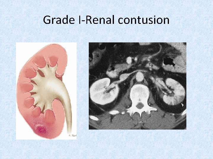 Grade I-Renal contusion 