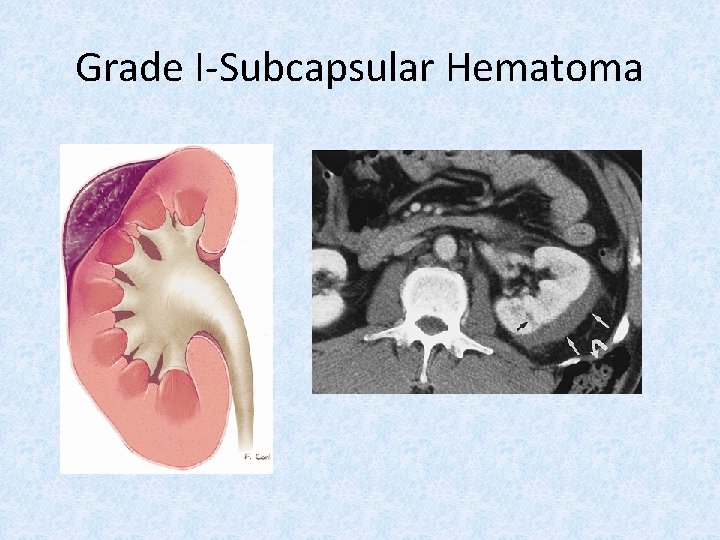 Grade I-Subcapsular Hematoma 