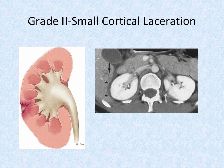 Grade II-Small Cortical Laceration 