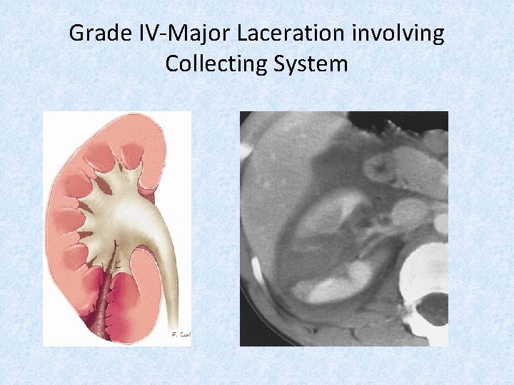 Grade IV-Major Laceration involving Collecting System 