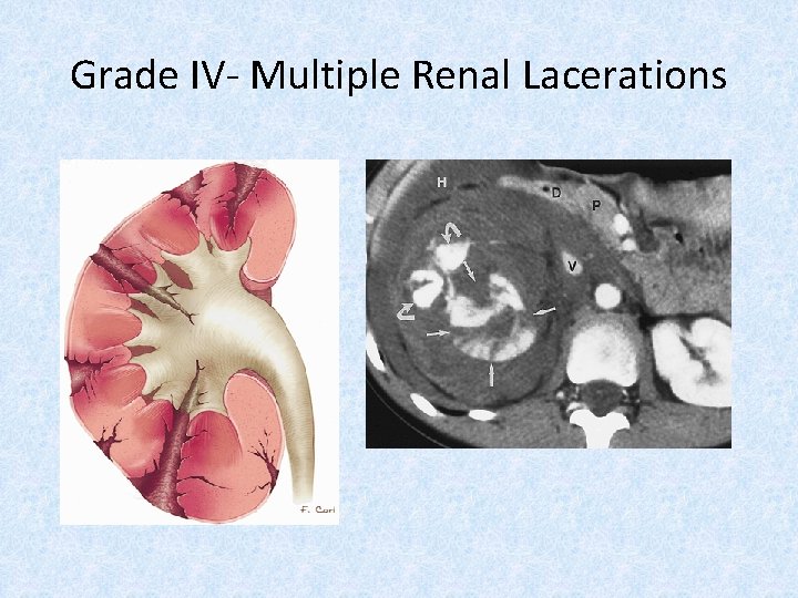 Grade IV- Multiple Renal Lacerations 