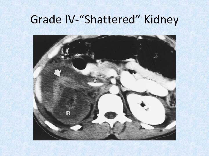 Grade IV-“Shattered” Kidney 