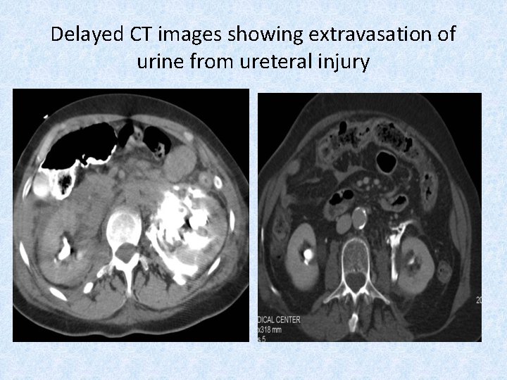 Delayed CT images showing extravasation of urine from ureteral injury 