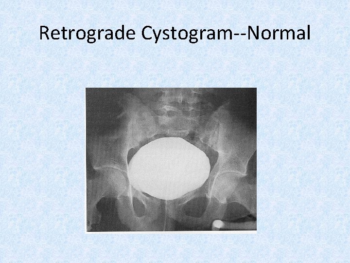 Retrograde Cystogram--Normal 