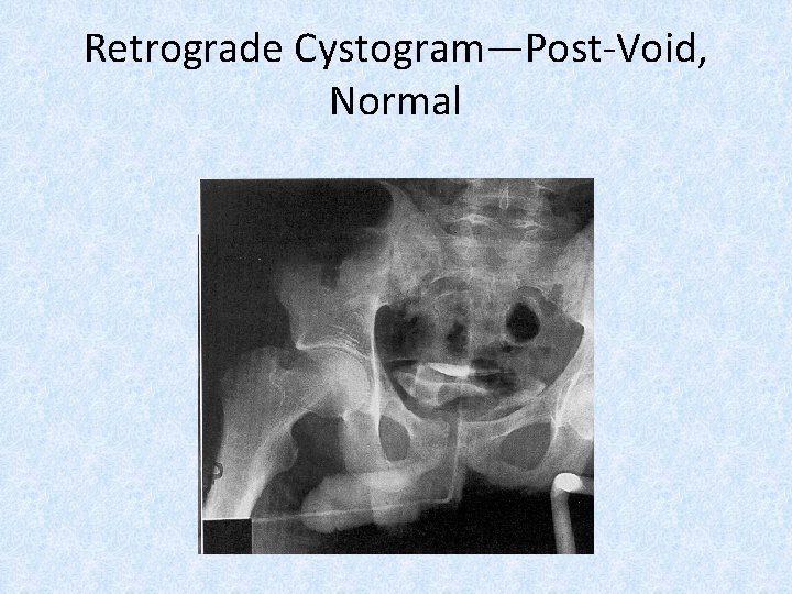 Retrograde Cystogram—Post-Void, Normal 