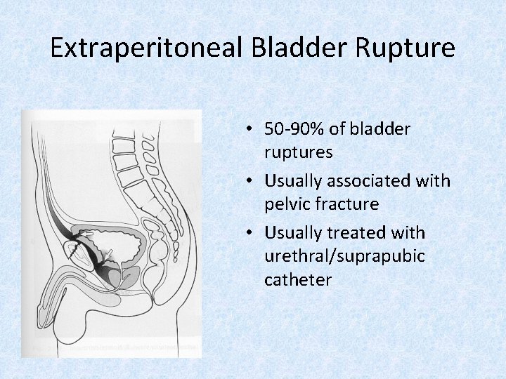 Extraperitoneal Bladder Rupture • 50 -90% of bladder ruptures • Usually associated with pelvic