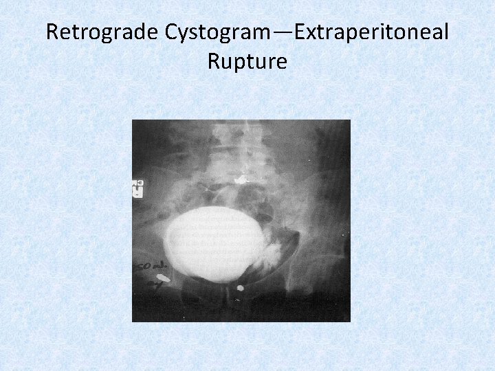 Retrograde Cystogram—Extraperitoneal Rupture 