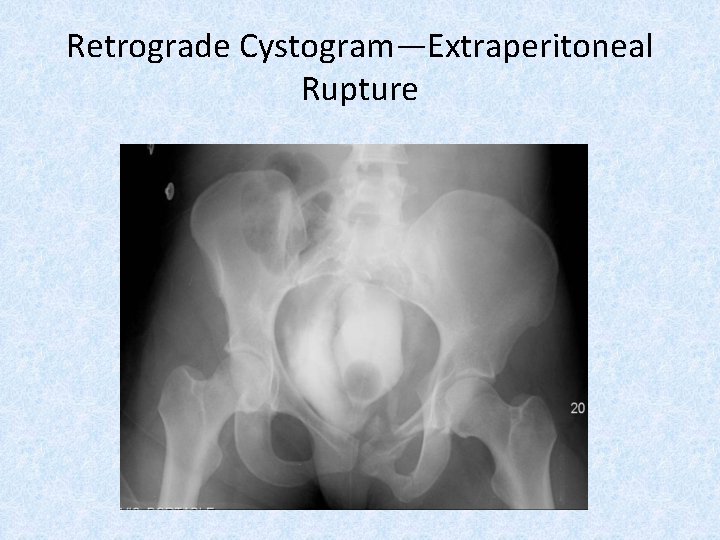 Retrograde Cystogram—Extraperitoneal Rupture 