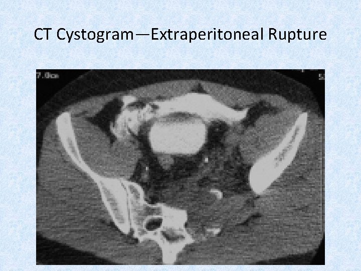 CT Cystogram—Extraperitoneal Rupture 