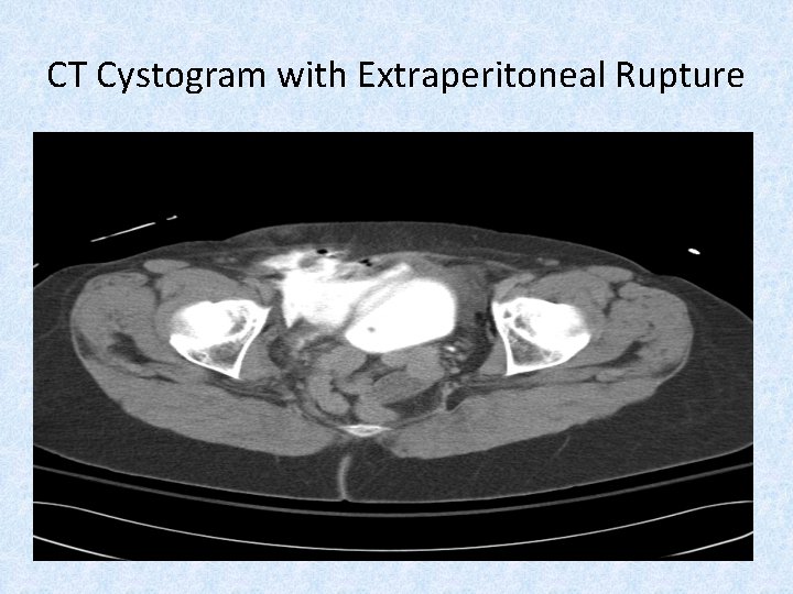 CT Cystogram with Extraperitoneal Rupture 