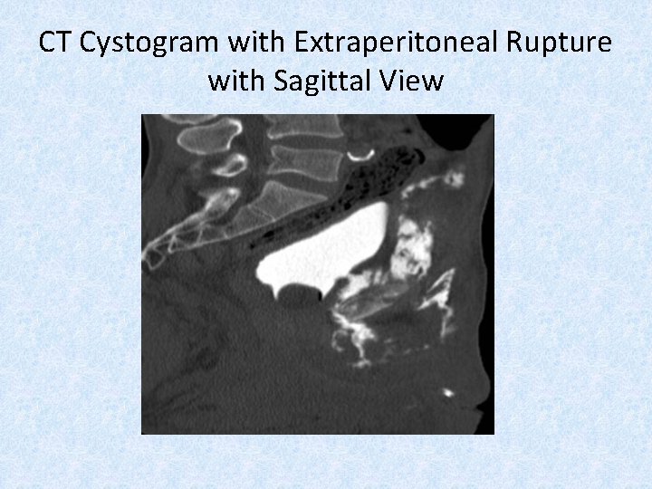 CT Cystogram with Extraperitoneal Rupture with Sagittal View 