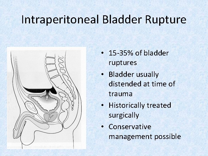 Intraperitoneal Bladder Rupture • 15 -35% of bladder ruptures • Bladder usually distended at