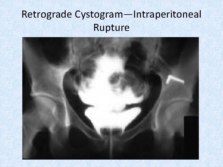 Retrograde Cystogram—Intraperitoneal Rupture 