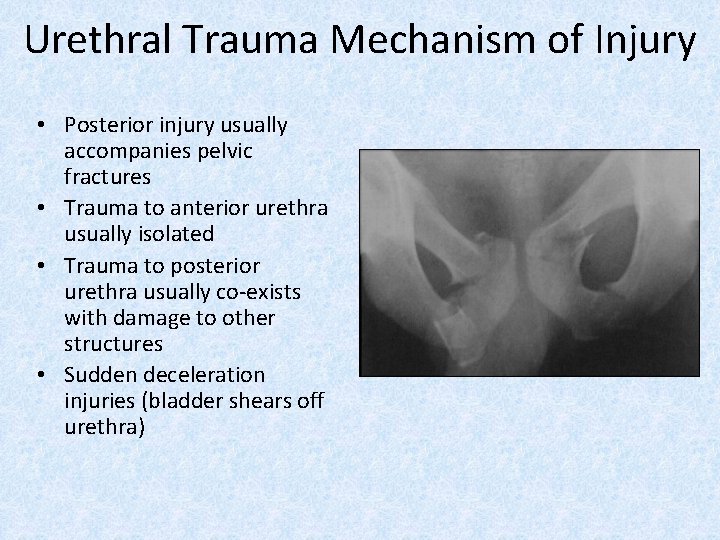 Urethral Trauma Mechanism of Injury • Posterior injury usually accompanies pelvic fractures • Trauma