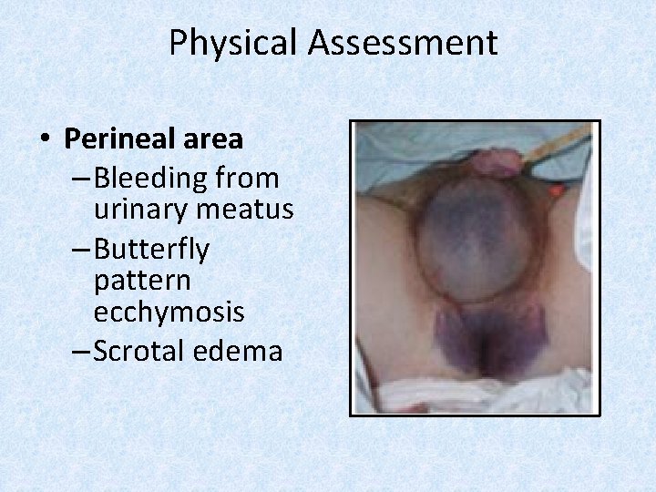 Physical Assessment • Perineal area – Bleeding from urinary meatus – Butterfly pattern ecchymosis