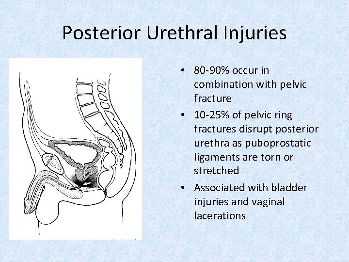 Posterior Urethral Injuries • 80 -90% occur in combination with pelvic fracture • 10