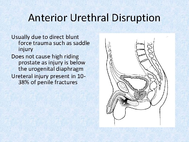 Anterior Urethral Disruption Usually due to direct blunt force trauma such as saddle injury