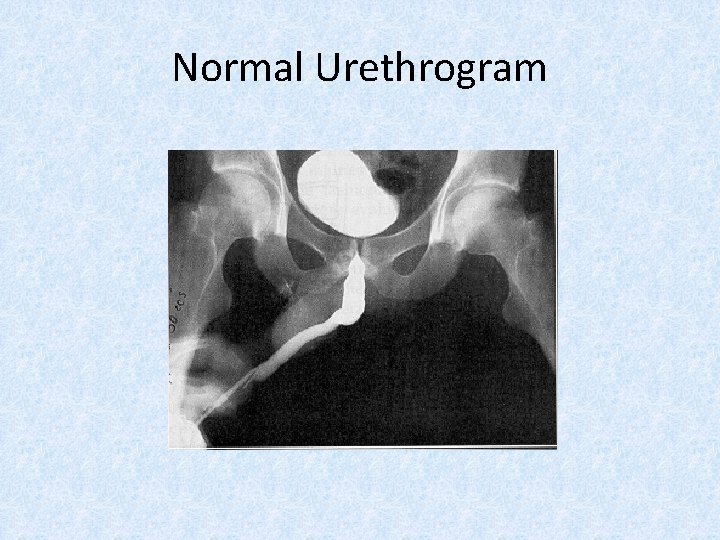Normal Urethrogram 