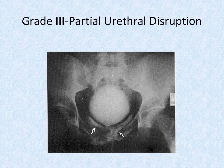 Grade III-Partial Urethral Disruption 
