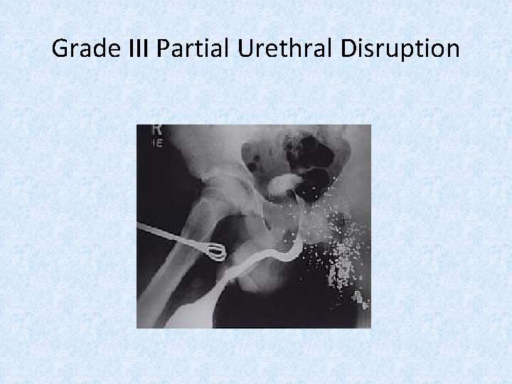 Grade III Partial Urethral Disruption 