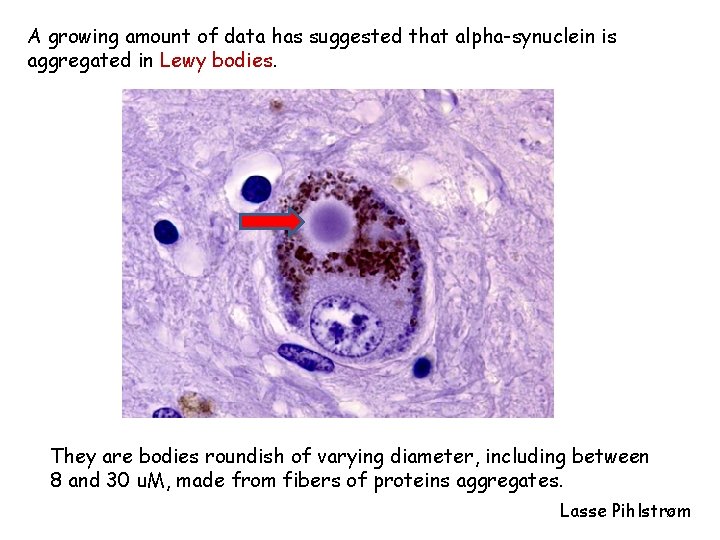 A growing amount of data has suggested that alpha-synuclein is aggregated in Lewy bodies.