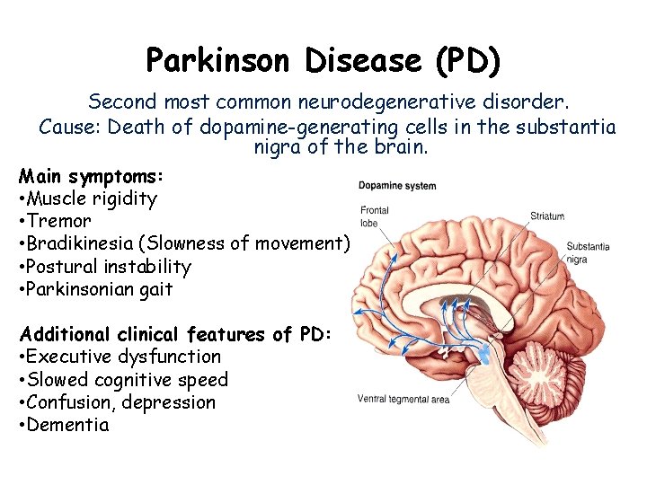 Parkinson Disease (PD) Second most common neurodegenerative disorder. Cause: Death of dopamine-generating cells in