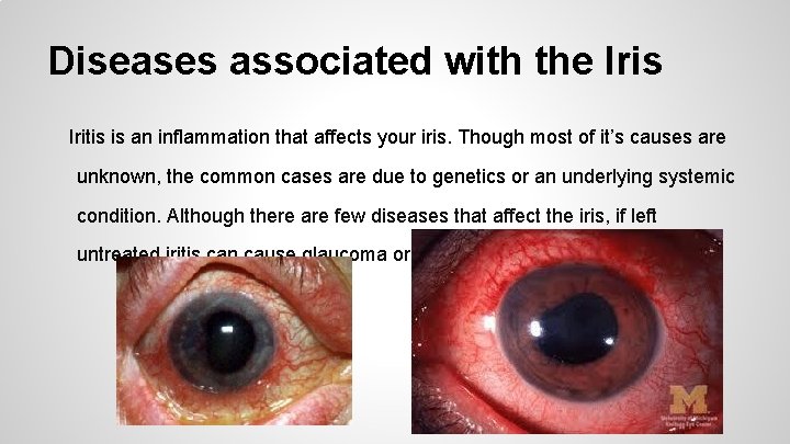 Diseases associated with the Iris Iritis is an inflammation that affects your iris. Though