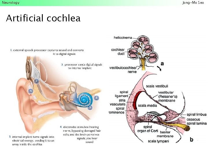 Neurology Artificial cochlea Jong-Mo Seo 