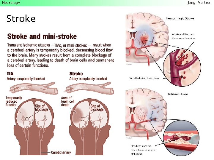 Neurology Stroke Jong-Mo Seo 