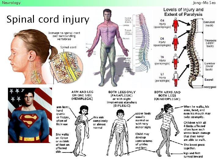 Neurology Spinal cord injury Jong-Mo Seo 