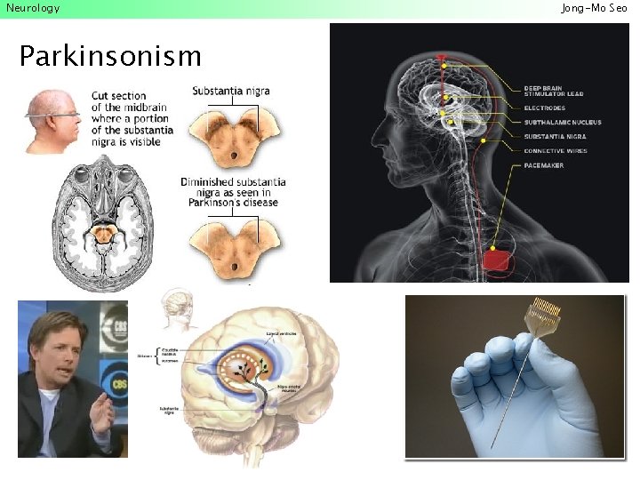 Neurology Parkinsonism Jong-Mo Seo 