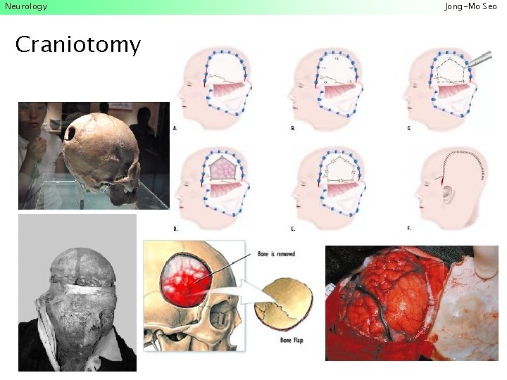 Neurology Craniotomy Jong-Mo Seo 