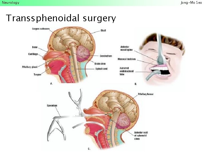 Neurology Transsphenoidal surgery Jong-Mo Seo 