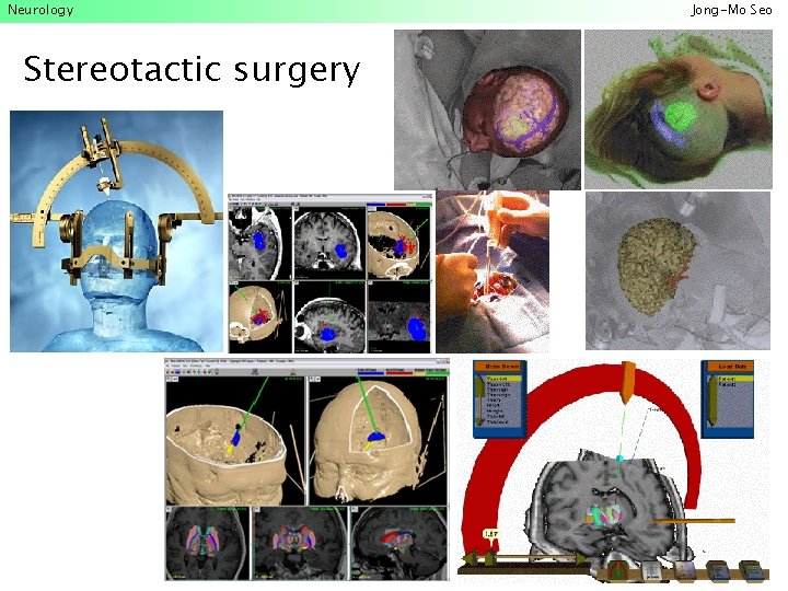 Neurology Stereotactic surgery Jong-Mo Seo 