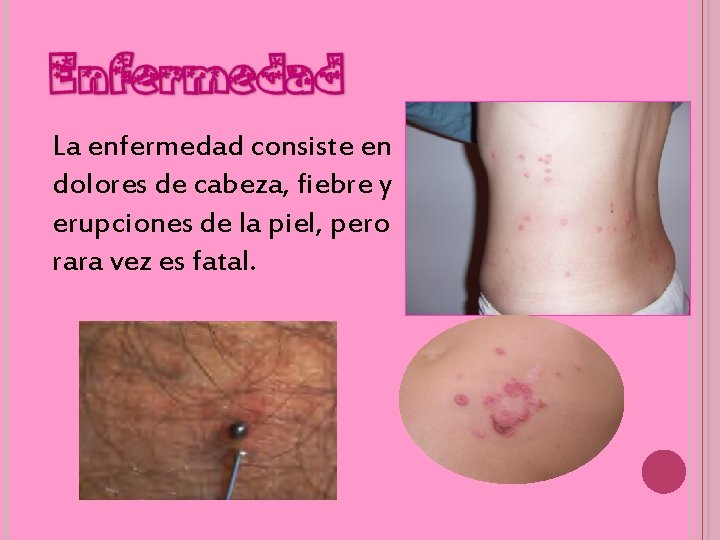 Enfermedad La enfermedad consiste en dolores de cabeza, fiebre y erupciones de la piel,