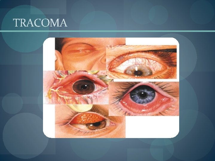 TRACOMA 
