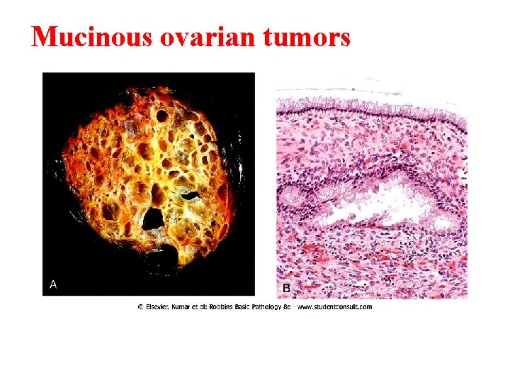 Mucinous ovarian tumors 