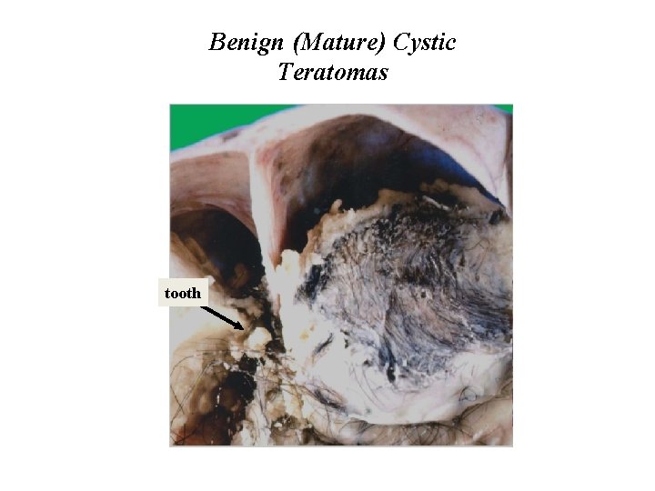Benign (Mature) Cystic Teratomas tooth 