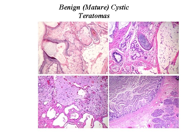 Benign (Mature) Cystic Teratomas 