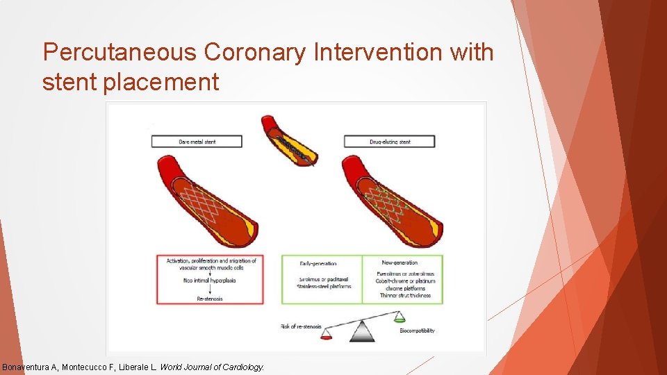 Percutaneous Coronary Intervention with stent placement Bonaventura A, Montecucco F, Liberale L. World Journal