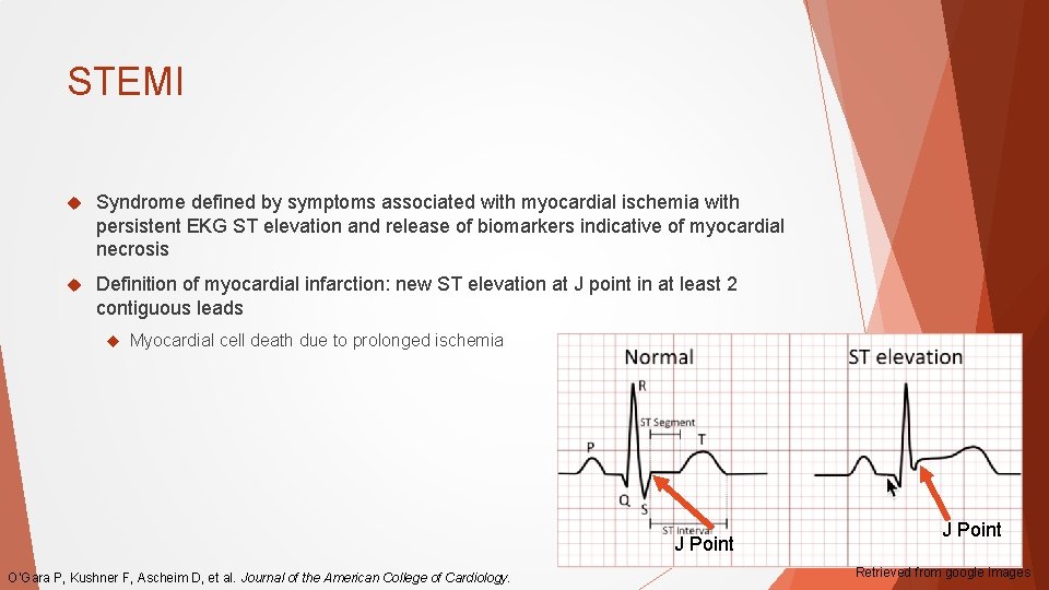STEMI Syndrome defined by symptoms associated with myocardial ischemia with persistent EKG ST elevation