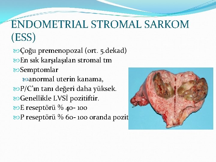 ENDOMETRIAL STROMAL SARKOM (ESS) Çoğu premenopozal (ort. 5. dekad) En sık karşılan stromal tm