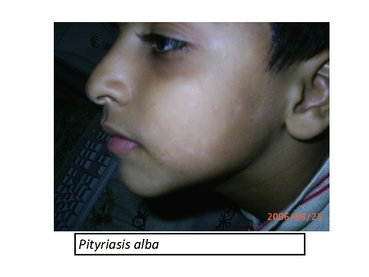 Pityriasis alba 